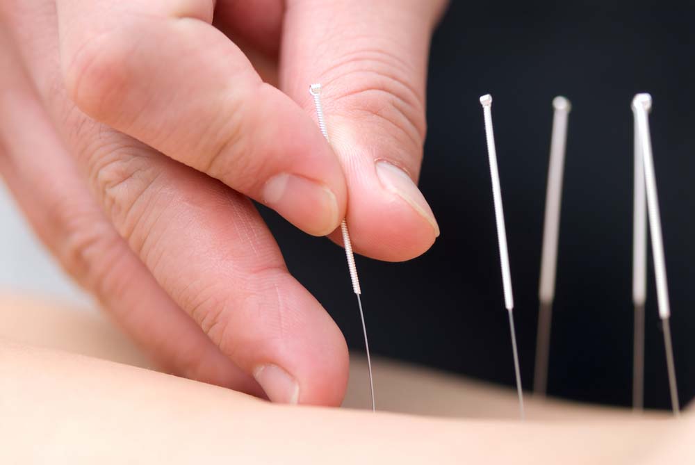 Read more about the article Acupuncture for Lower Back Pain